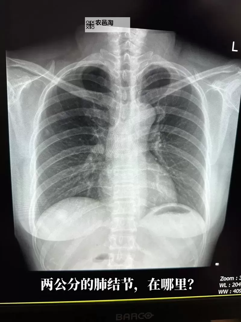 2023年胸片曝光没有衣服事件引发热议图1