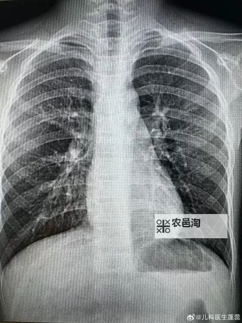 免费福利！胸片100%曝光九一免费，全面检测守护健康图1